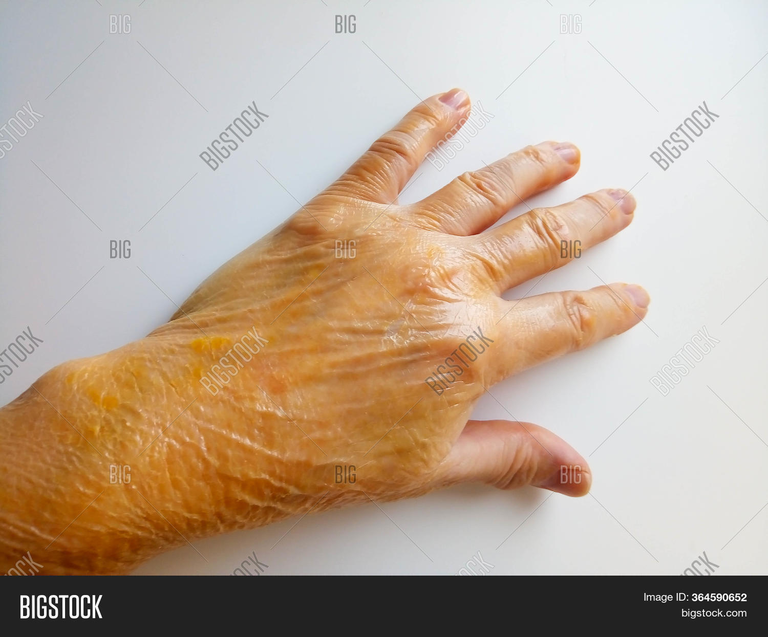 Oilment For Hand Rash On Hand, Ointment Image & Photo (Free Trial) | Bigstock