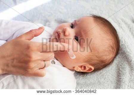 Baby With Atopic Dermatitis Getting Cream Put. Care And Prevention Of Eczema.