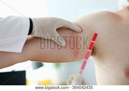 Close-up Of Doctor Dermatologist Doing Test Of Body Stain. Allergic Urticaria On Dermal Edema Quinck