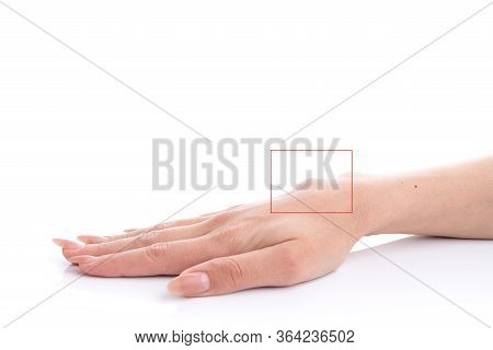 Ganglion Cyst On Woman Hand Circled In Red Square Isolated On White Background