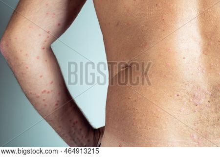 Back View Of Bare Elbow And Back Of Unrecognizable Man Showing Inflamed Scaly Flaky Affected Skin Wi