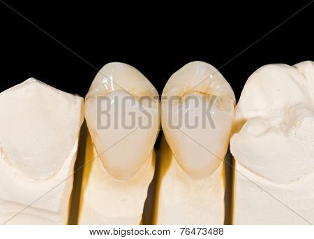Ceramic Crowns