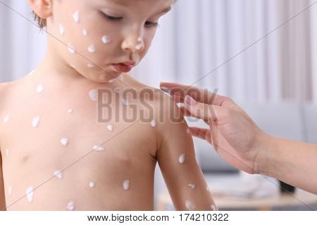 Woman applying cream onto skin of child ill with chickenpox, on blurred background