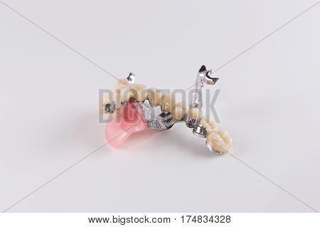 Clasp prosthesis with and attachments fixing ceramic crowns