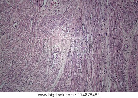 Cells of human uterus tissue with inoffensive tumor cells under a microscope.