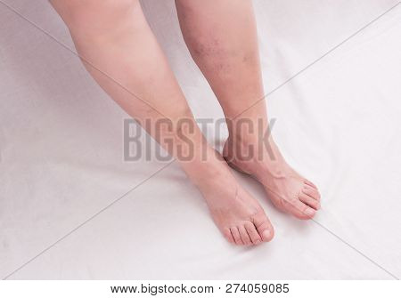 Legs Of An Old Woman On A White Background With Varicose Veins On The Legs, Phlebeurysm, Anatomy