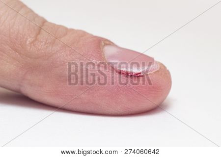 Finger With Severed Nail And Burr, Blood, Macro, White Background, Cuticle, Copy Space, Barb