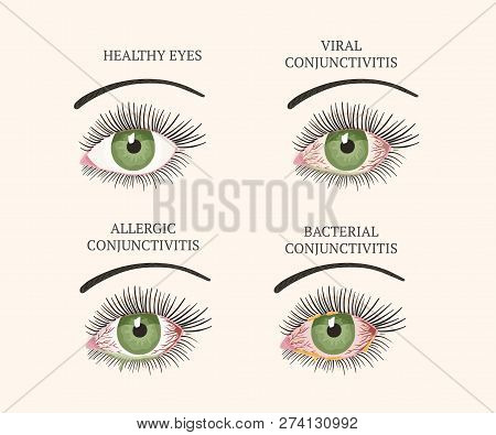 Conjunctivitis, Pink Eyes. Eye Disease. Ophthalmology Flat Health Illustration. Most Common Conjunct