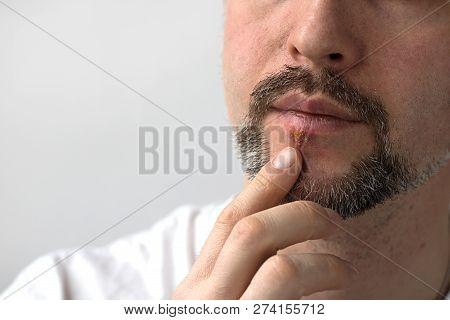 Medicine Illness Herpes Man Beard Healthy