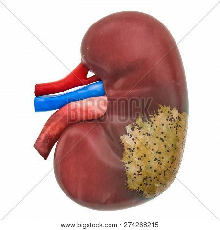 Kidney Disease Concept, 3d Rendering Isolated On White Background