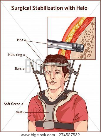 Lateral View Of Adult Male In Halo Vest Traction