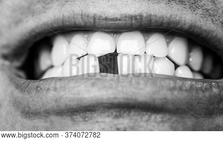 Bad Dental Health, No Teeth, No Fluoride, Tooth Erosion. Man Without One Front Tooth. No Teeth. Smil