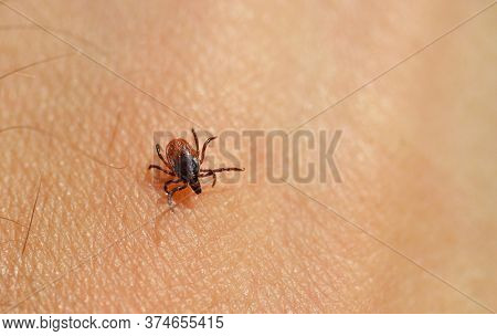 Tick ( Ixodes ricinus ) on human skin. Parasite transmit both Lyme Borrelia and Tick-Borne Encephalitis.