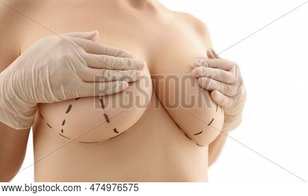 Woman Shows Surgical Recommendations Marked By Surgeon For Mastectomy Or Breast Implant On Naked Fem