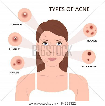 Types of acne. Girl with skin problems. Woman with pimples on the face. Vector illustration flat design