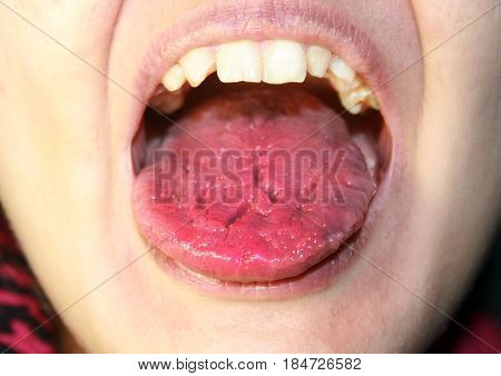 The tongue is red, inflamed. Hyperemia of the mucous membrane of the tongue.