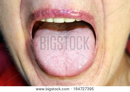 The tongue is in a white raid. Candidiasis in the tongue.