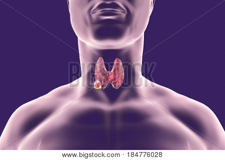 Thyroid cancer. 3D illustration showing thyroid gland with tumor inside human body