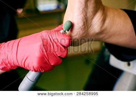 Podology, Treatment Of The Affected Areas Of The Feet, Medical Office, Pedicure