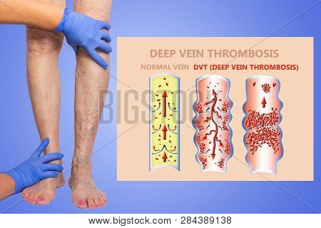 Deep Vein Thrombosis Or Blood Clots. Embolus. Structure Of Normal And Varicose Female Veins