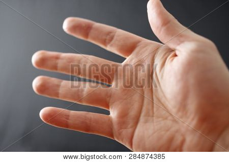 Adult Hand With Raynaud's Syndrome - Phenomenon. Close Up Hand With Fingers On Dark Background With 