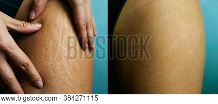 Before And After Photos Of Female Hip Stretch Marks On Woman's Legs