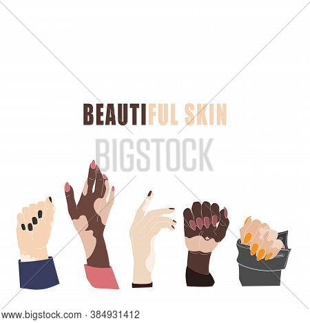 Hands With Age Spots Or Vitiligo Isolated Vector. Hand Gestures With Genetic Skin Disease. Womans Ha