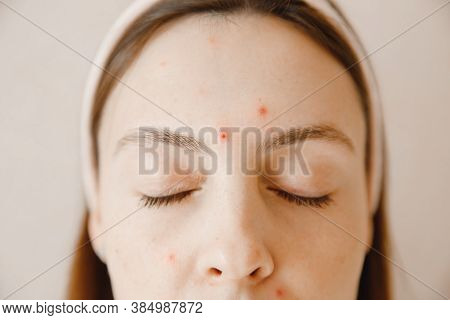 Skin Of Face Of Young Woman Is Affected By Chickenpox, Acne Defects