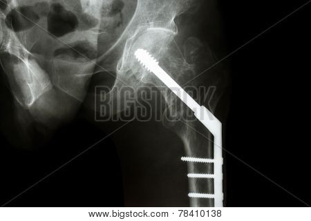 Fracture Neck Of Femur(thigh's Bone). Patient Was Operated And Fixed Bone By Screw