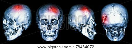 Ct Scan Of Human Skull And 3D With Stroke (cerebrovascular Accident)