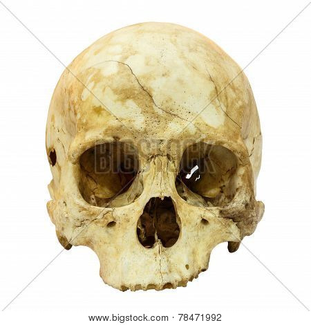 Human Skull Fracture (mongoloid,asian) On Isolated Background