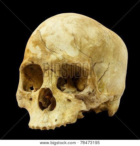Human Skull Fracture(side) ( Mongoloid , Asian ) on isolated background