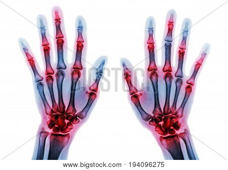 Arthritis multiple joint of fingers . Film x-ray of both hands and wrists .