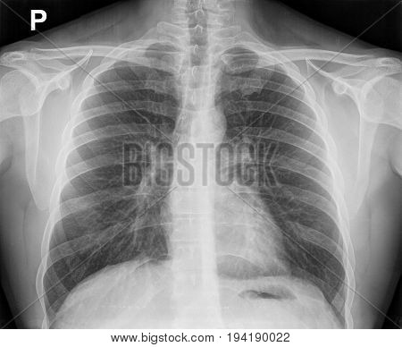 X-ray Image Of The Chest Showing The Internal Anatomy Of The Rib Cage.