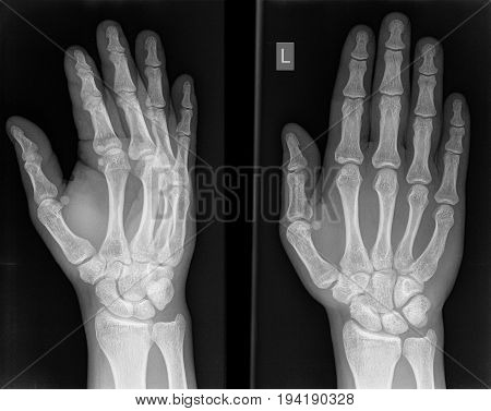 X-ray Photo Of A Hand.