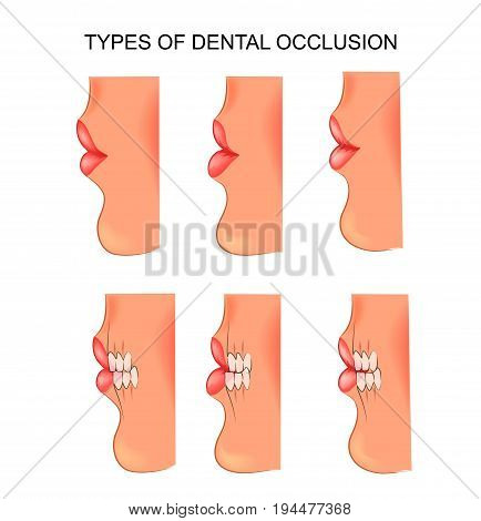 vector illustration of a dental occlusion. dentistry