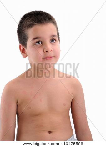 Little boy Ã?Ã?s body suffering severe allergic reaction - a series of URTICARIA images.