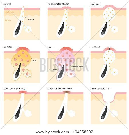 Illustration of acne formation on the human skin