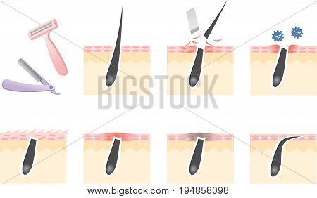Illustration of razor shaving skin troubles on the human skin
