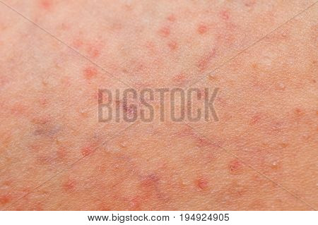 Close up picture of folliculitis problem on female skin