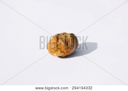 Stone Of The Gallbladder. The Result Of Gallstones. A Calculus Of Heterogeneous Composition.