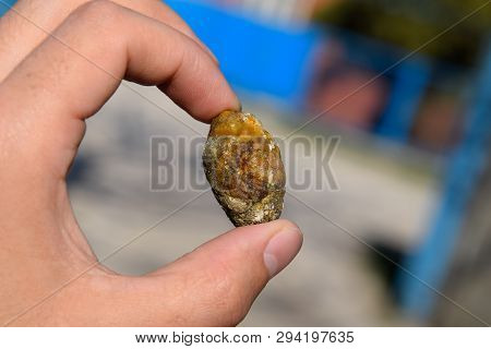 Stone Of The Gallbladder. The Result Of Gallstones. A Calculus Of Heterogeneous Composition Against 