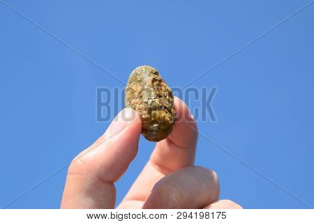 Stone Of The Gallbladder. The Result Of Gallstones. A Calculus Of Heterogeneous Composition Against 