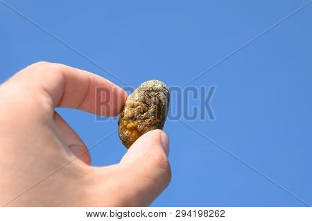 Stone Of The Gallbladder. The Result Of Gallstones. A Calculus Of Heterogeneous Composition Against 