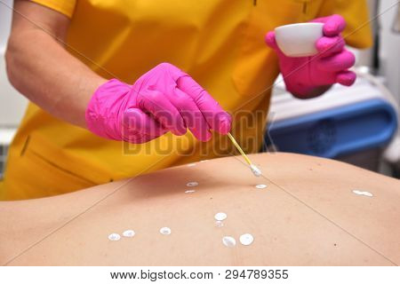 Acne treatment with zinc ointment. The back of a woman. The hands of a cosmetologist smear skin rash