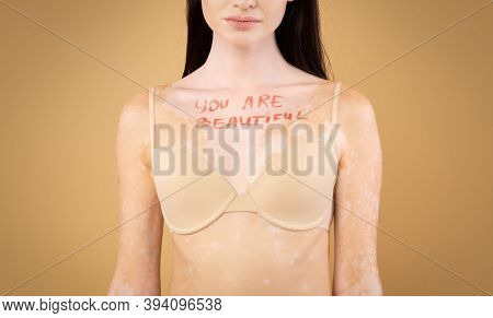 You Are Beautiful Motivational Inscription On Chest Of Skinny Woman With Vitiligo Disorder, Young Fe