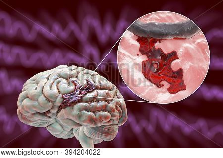 Hemorrhagic Stroke, 3d Illustration Showing Hemorrhage On The Brain Surface And Closeup View Of The 
