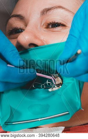 A Patient At A Dentists Appointment, A Doctor Uses A Rubber Dam To Treat Teeth, Disinfects A Tooth F