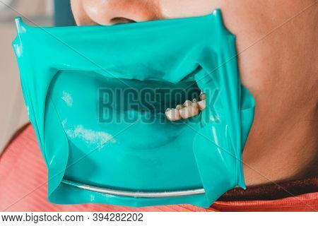 The Dentist Installs A Rubber Dam, Sterile Dental Treatment, Modern Equipment In Dentistry.