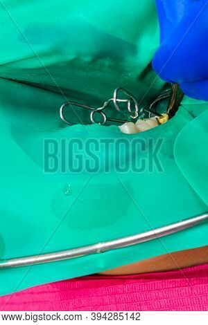A Patient At A Dentists Appointment, A Doctor Uses A Rubber Dam To Treat Teeth, Disinfects A Tooth F